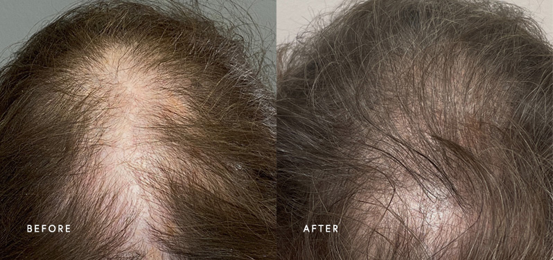 Restore Your Hair With Dermaster's Exclusive PRP Injection
